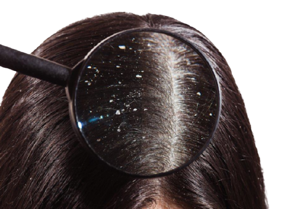 Dandruff Treatment